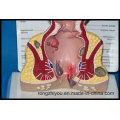 Pathologisches Modell Rectum Anatomisches Modell